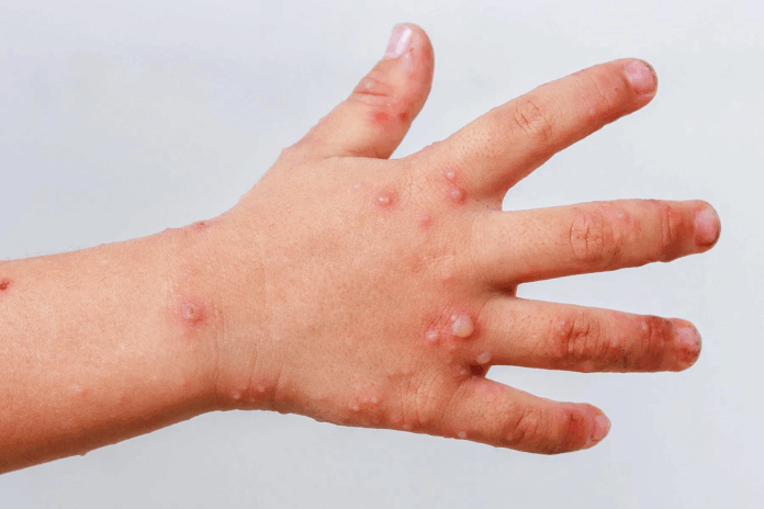 La Secretaría de Salud confirmó un brote del virus Coxsackie en Amalucan, Puebla. Un menor resultó contagiado y se suspendieron clases para evitar más casos.